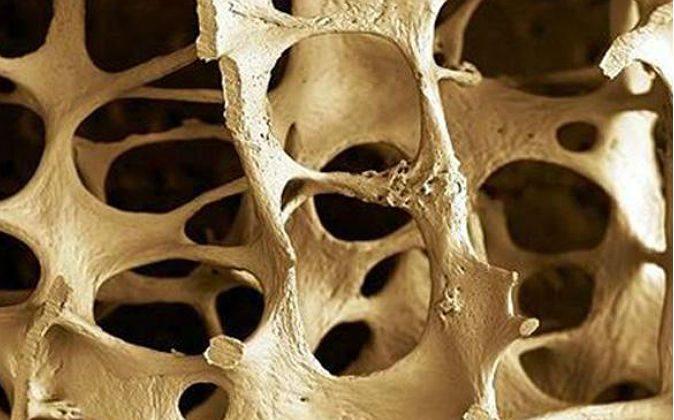 Osteoporosis Is Scurvy of the Bone, Not Calcium Deficiency