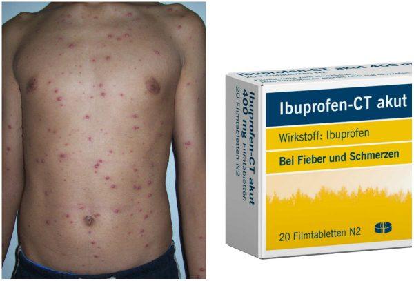 Left: Chicken pox. (Public Domain); Right: Ibuprofen - CT akut 400mg. (CT Arzneimittel GmbH/CC BY-ND 2.0)