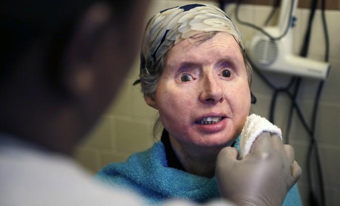Charla Nash: Chimp Attack Victim in Hospital After Body Starts Rejecting Face Transplant