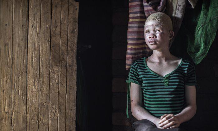 Surge in Albinos Targeted and Killed in Malawi for Rituals: Amnesty