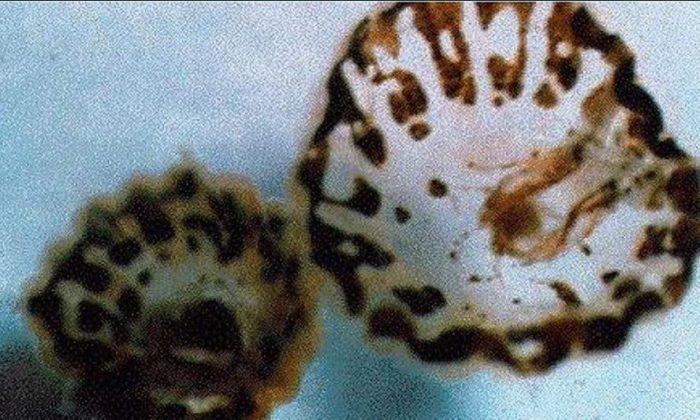 ‘Sea Lice’ Outbreaks Reported in Florida, Texas