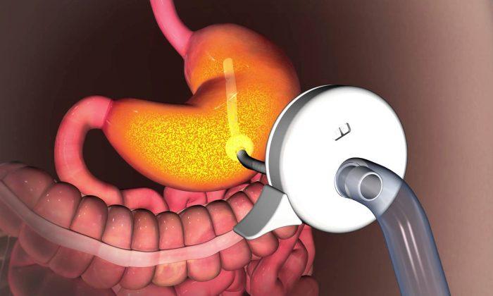 To Combat Obesity, FDA Approves Tube That Drains Food From the Stomach