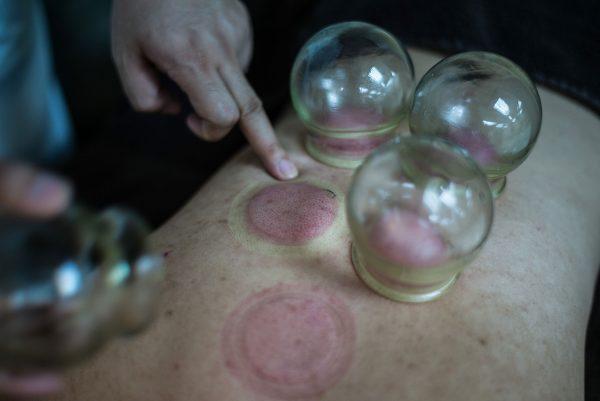 A patient receives cupping treatment at a Chinese medicine clinic in Hong Kong on Aug. 10, 2016. The Chinese treatment, also known as "ba guan," utilizes heated glass cups to create a suction on the patient's skin, causing a circular mark that looks like bruising on the skin. (Lam Yik Fei/Getty Images)