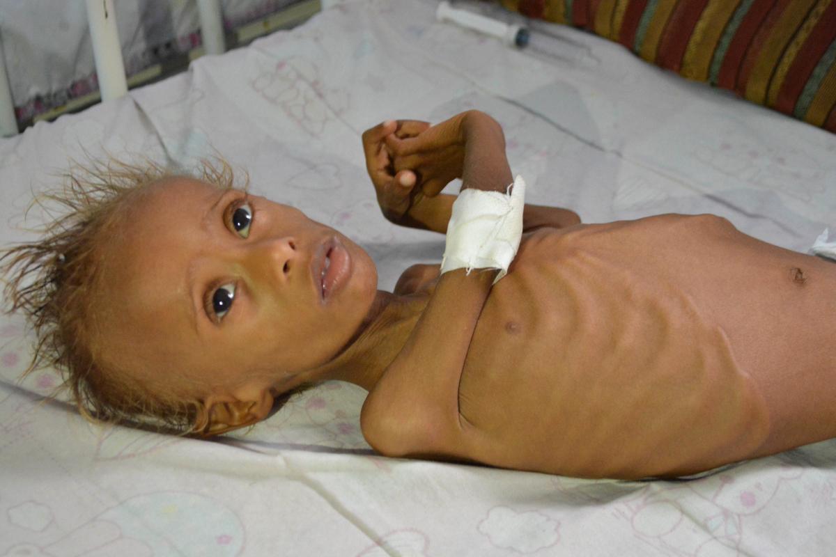Ravaged by Conflict, Yemen's Coast Faces Rising Malnutrition