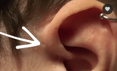 Why Some People Have a Small Hole in Front of Upper Ear (Video)