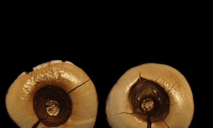 13,000-Year-Old Teeth Reveal Dental Fillings Were Torture Back Then (Video)