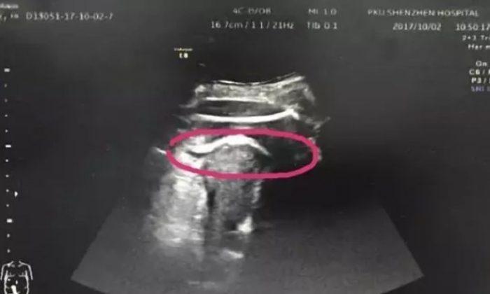 Unborn Child Kicks Mother, Injures Her: Doctors