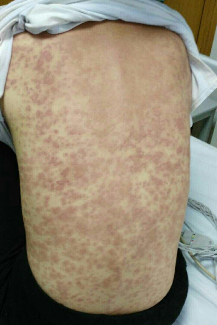 Photo of a student with rash all over his back. (Provided by Ding Ling)