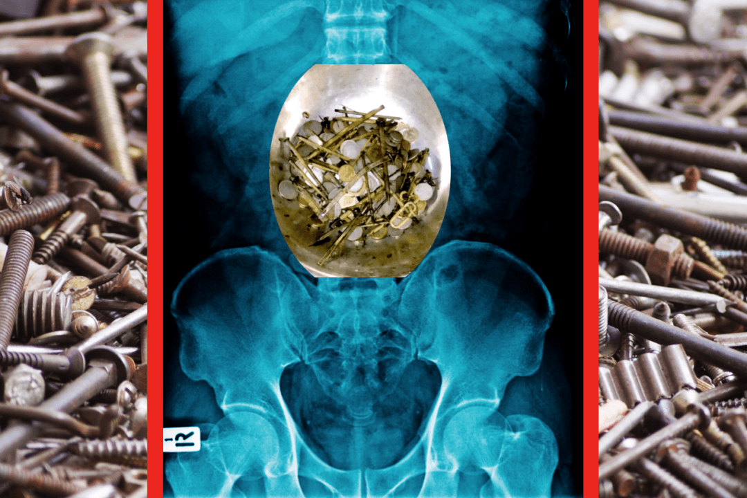 Surgeons Remove 15 pounds of Nails, Coins from Man’s Stomach