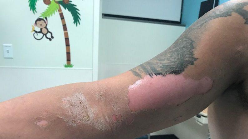 Virginia Teenager Hospitalized After Touching a Giant Hogweed Plant