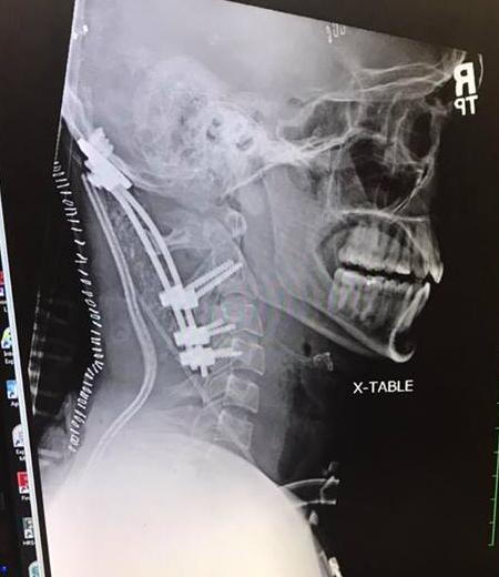 Brock Meister's X-ray showing the extent of injuries that needed repair. (Beacon Health System)