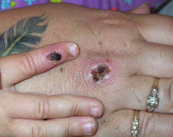 Monkeypox lesions on a patient's hand in one of the first known cases of the virus in the United States, on May 27, 2003. (Courtesy of CDC/Getty Images)