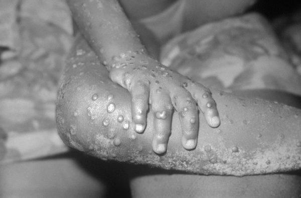 Monkeypox-like lesions on the arm and leg of a girl in Bondua, Liberia, in an undated image from 1971. (Courtesy of the CDC/Getty Images)