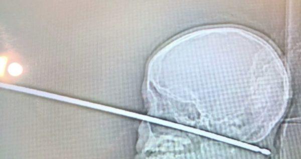 An X-ray shows the metal meat skewer penetrating the head of Xavier Cunningham, Sept. 8, 2018. (Screenshot/Fox)