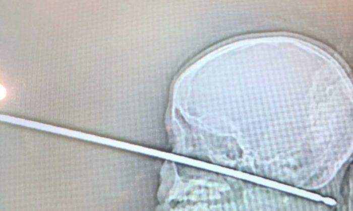 10-Year-Old Survives Impaling Himself Face-First on Skewer
