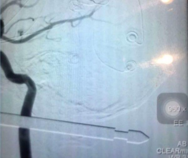An X-ray shows the tip of the metal meat skewer that penetrated the head of Xavier Cunningham, on Sept. 8, 2018. (Screenshot/Fox)