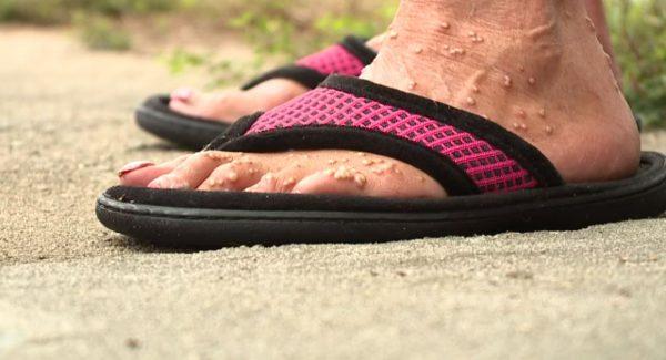 Donna Kearns showing her feet after they were stung by fire ants in Archdale, North Carolina, on Sept. 22, 2018. (WGHP/Fox)