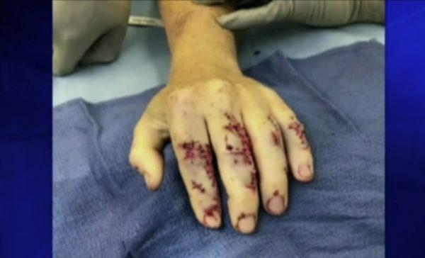 Maggie Ewing's hand after surgery reveals multiple shark tooth cuts from an attack on a spearfishing trip in the Bahamas on Sept. 24, 2018. (Fox/Screenshot)