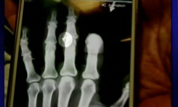 An X-ray shows a shark tooth left in Maggie Ewing's finger after a shark attack on a spearfishing trip in the Bahamas, on Sept. 24, 2018. (Fox/Screenshot)