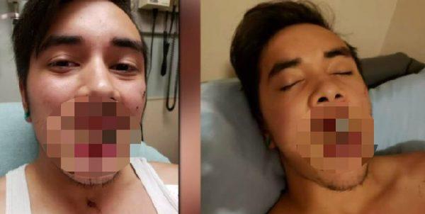 A man was hospitalized after a vape pen exploded, leaving him with a shattered jaw on Nov. 15, 2018. (Fox News)