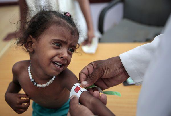 A doctor measures the arm of malnourished girl at the Aslam Health Center, Hajjah, Yemen, on Oct. 1, 2018. (Hani Mohammed/AP)