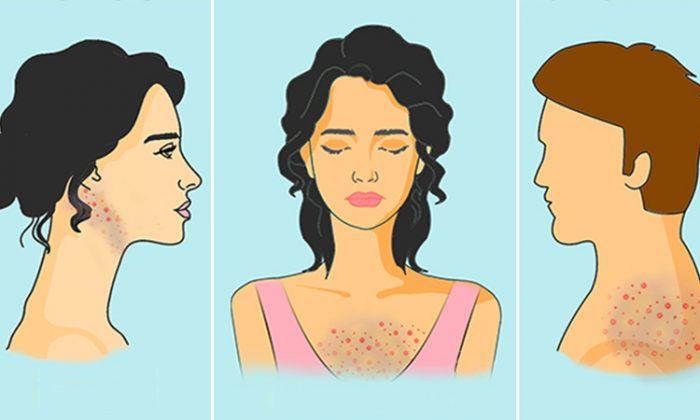 9 things that cause acne on different parts of the body—and how to improve your health!