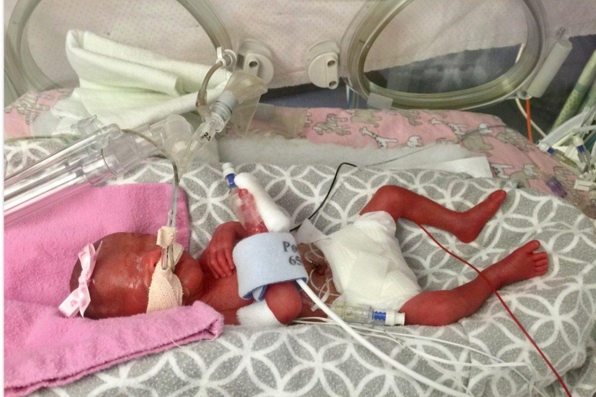 A picture shows Zariah Strong just after she was born at 23 weeks and 3 days after her mother experienced a placental abruption. (Zariah's Fight For Life/GoFundMe)