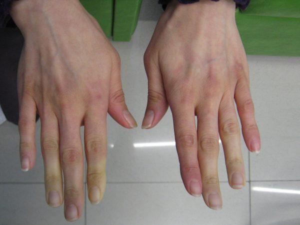 Patient with symptoms of Raynaud's (Intermedicho/ CC-BY-SA-3.0)