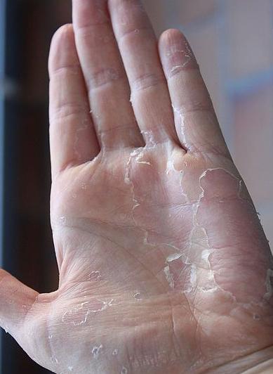 Dry hands (<a href="https://en.wikipedia.org/wiki/File:Scharlach.jpg#/media/File:Scharlach.jpg">Public domain</a>)