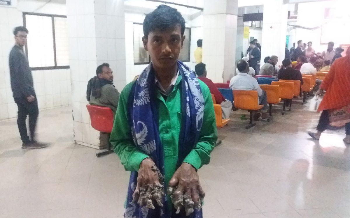 Abul Bajandar, dubbed the Bangladeshi "Tree Man", shows his hands at Dhaka hospital on Jan. 21, 2019 (STR/AFP)