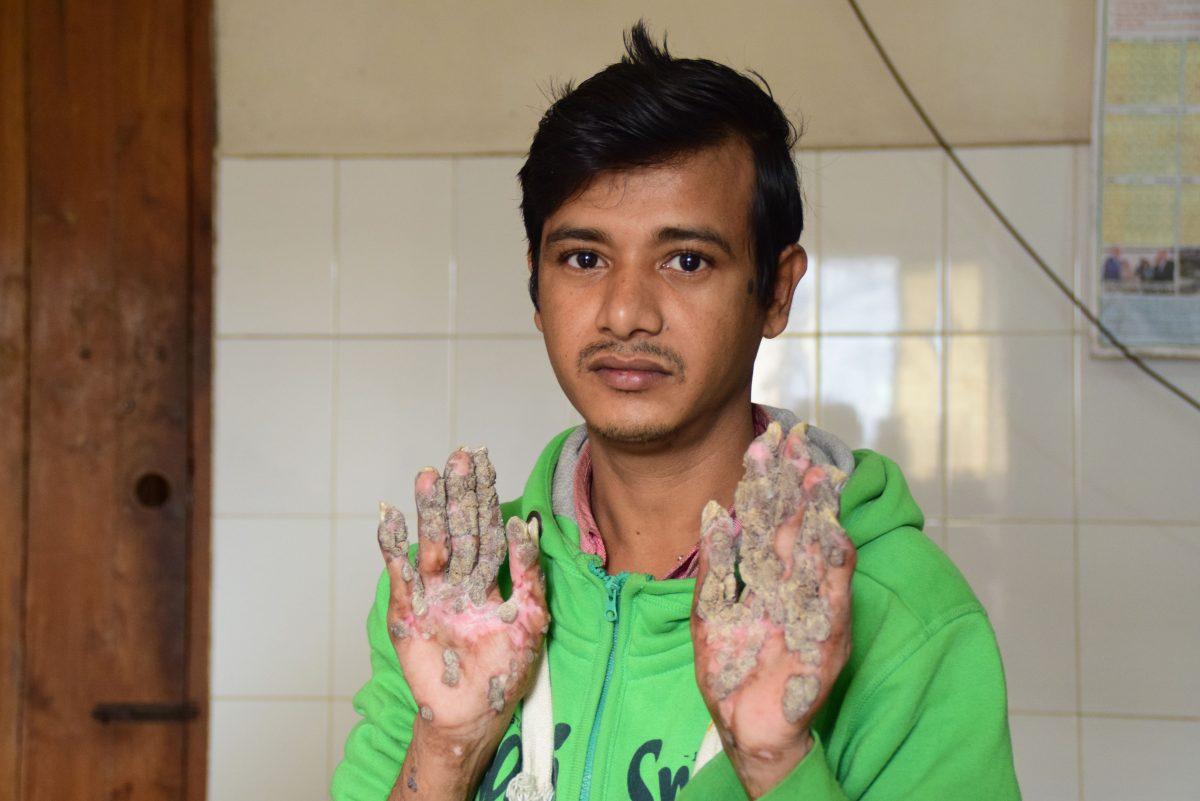 "Tree Man" Abul Bajandar showing his palms after surgery on Jan. 25, 2018. (Sam Jahan/AFP/Getty Images)