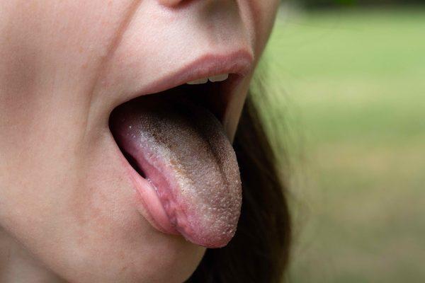 Hairy tongue (Sruilk/Shutter)