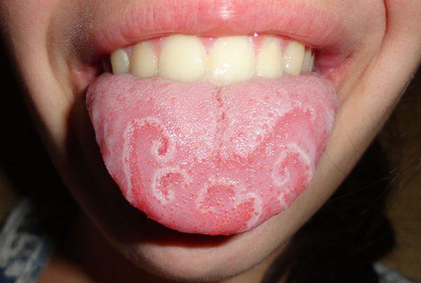 Geographic tongue (Martanopue/Wikimedia Commons)