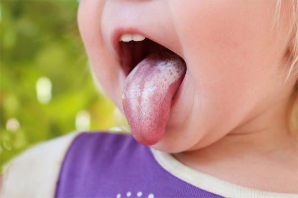 Oral thrush (Victoria/Shutterstock)