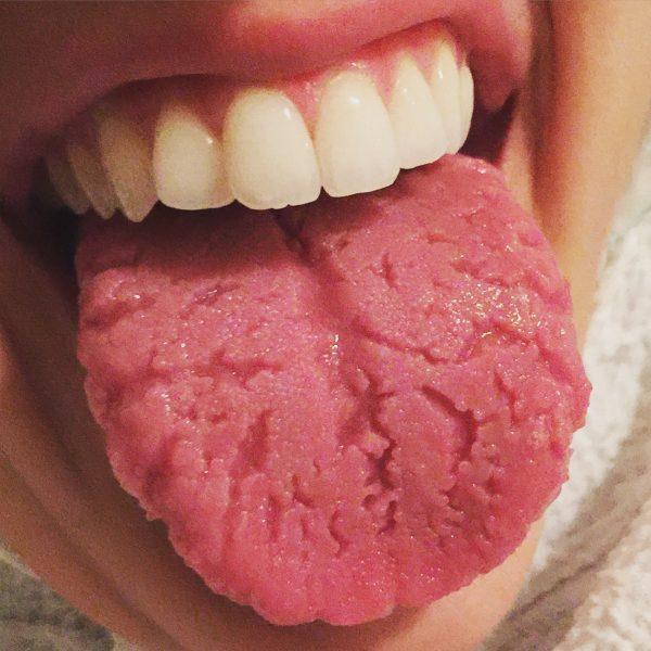 Fissured tongue (Lmossabasha064/Wikimedia Commons)