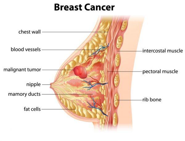 Breast Cancer (BlueRingMedia/Shutterstock)