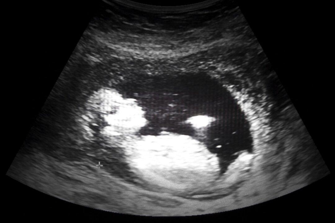 Georgia House Passes Bill to Ban Abortions After Fetal Heartbeat Detected