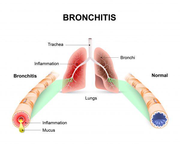 Bronchitis (Designua/Shutterstock)
