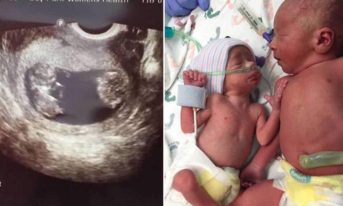 Mom Refuses Doctors’ Advice to Terminate One of Her Twins, 34 Weeks Later It’s the ‘Best Decision’