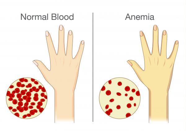 Anemia (Solar22/Shutterstock)