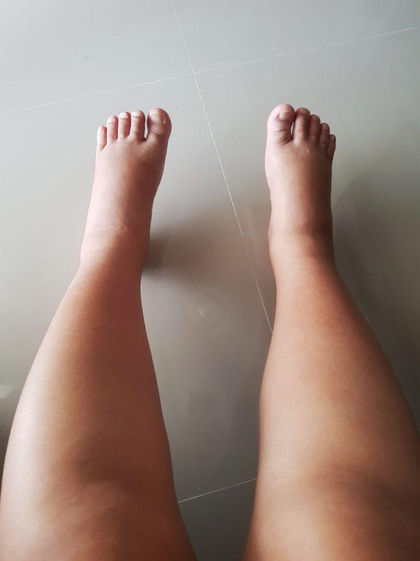 Swelling ankles and legs (JinAim-one/Shutterstock)