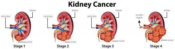 Four stages of kidney cancer (BlueRingMedia/Shutterstock)