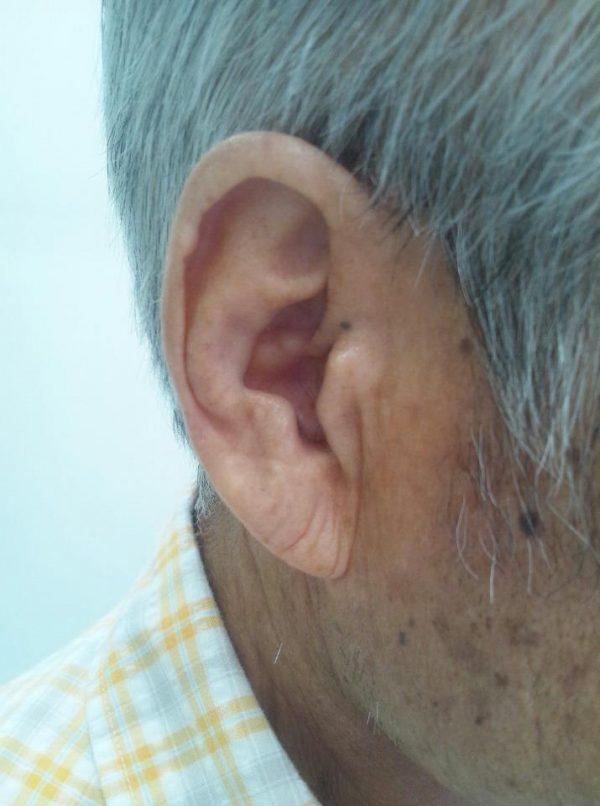 Earlobe creases can be indicative of heart disease (Med Chaos/Shutterstock)
