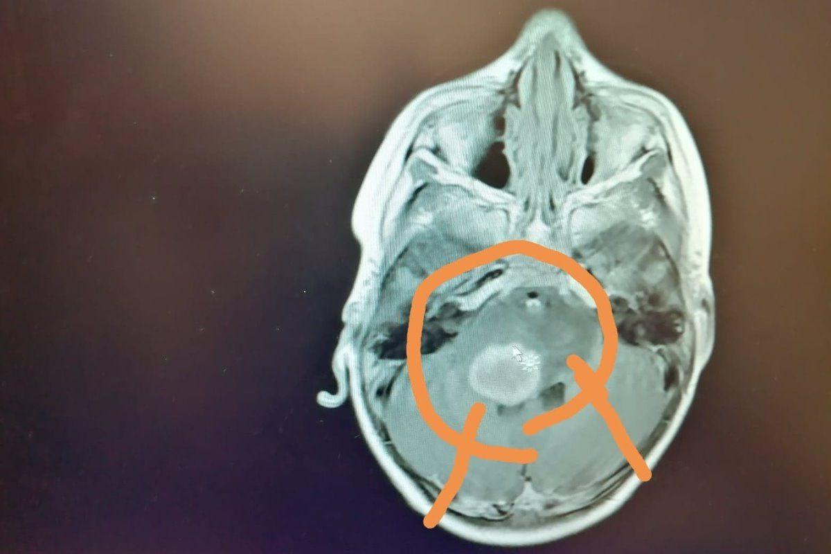 Picture of the massive tumor growing in Jack's brain. (Pic courtesy Wesley Lacey/GoFundMe)