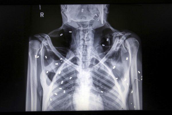 An X-ray image of air rifle pellets inside the body of a female orangutan named Hope. (Binsar Bakkara/AP Photo)