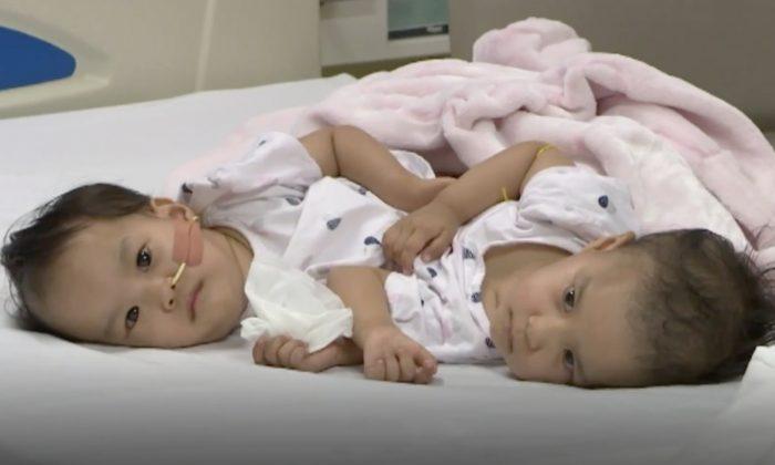 Conjoined Twin Sisters From Bhutan Successfully Separated, but Can’t Stop Snuggling