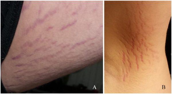 The “stretch mark” lesions that finally unraveled the boy’s mystery ailment, photographed in February 2017. (Breitschwerdt, et al/Journal of Central Nervous System Disease)