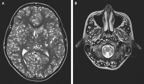 Two MRI scans show the cysts in a person's brain caused by the tapeworm infection. (Nishanth Dev, S. Zafar Abbas, New England Journal of Medicine)