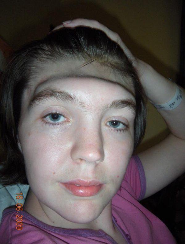 Grainne Kealy, pictured the day before surgeons fitted a ceramic forehead on June 16, 2009. (Grainne Kealy)