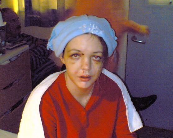 Grainne Kealy, pictured a week after her car accident in December 2006. (Grainne Kealy)